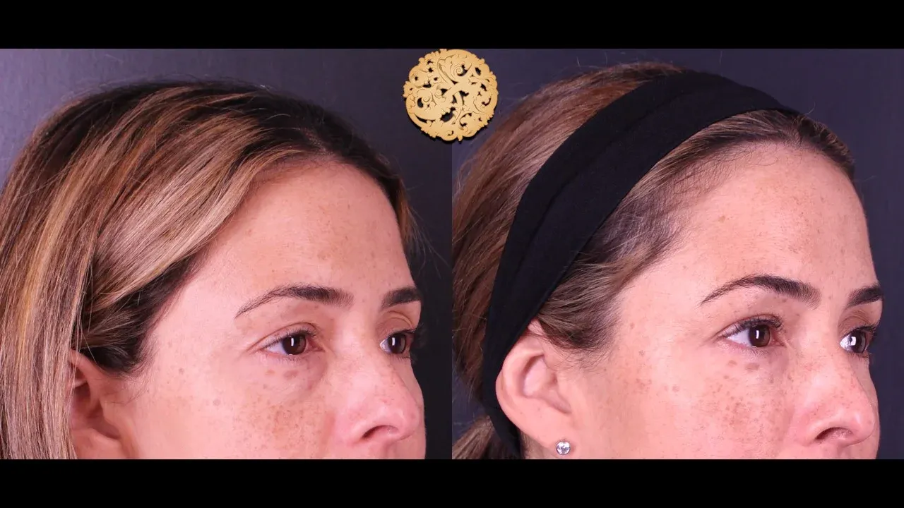 Under Eye Filler Before & After