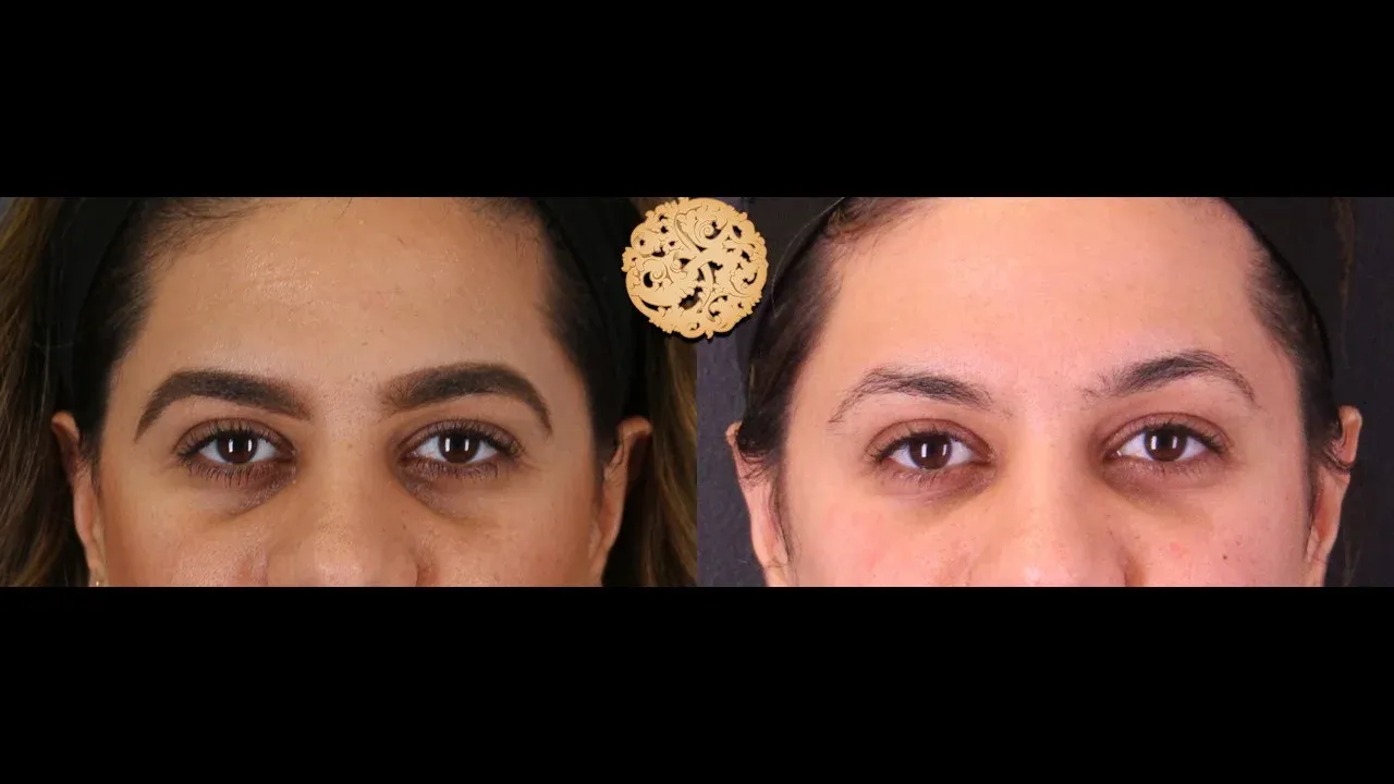 Under Eye Filler Before & After