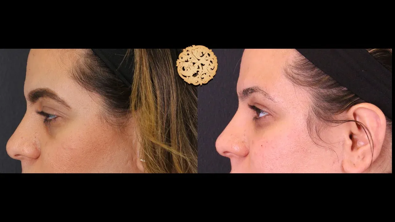 Under Eye Filler Before & After
