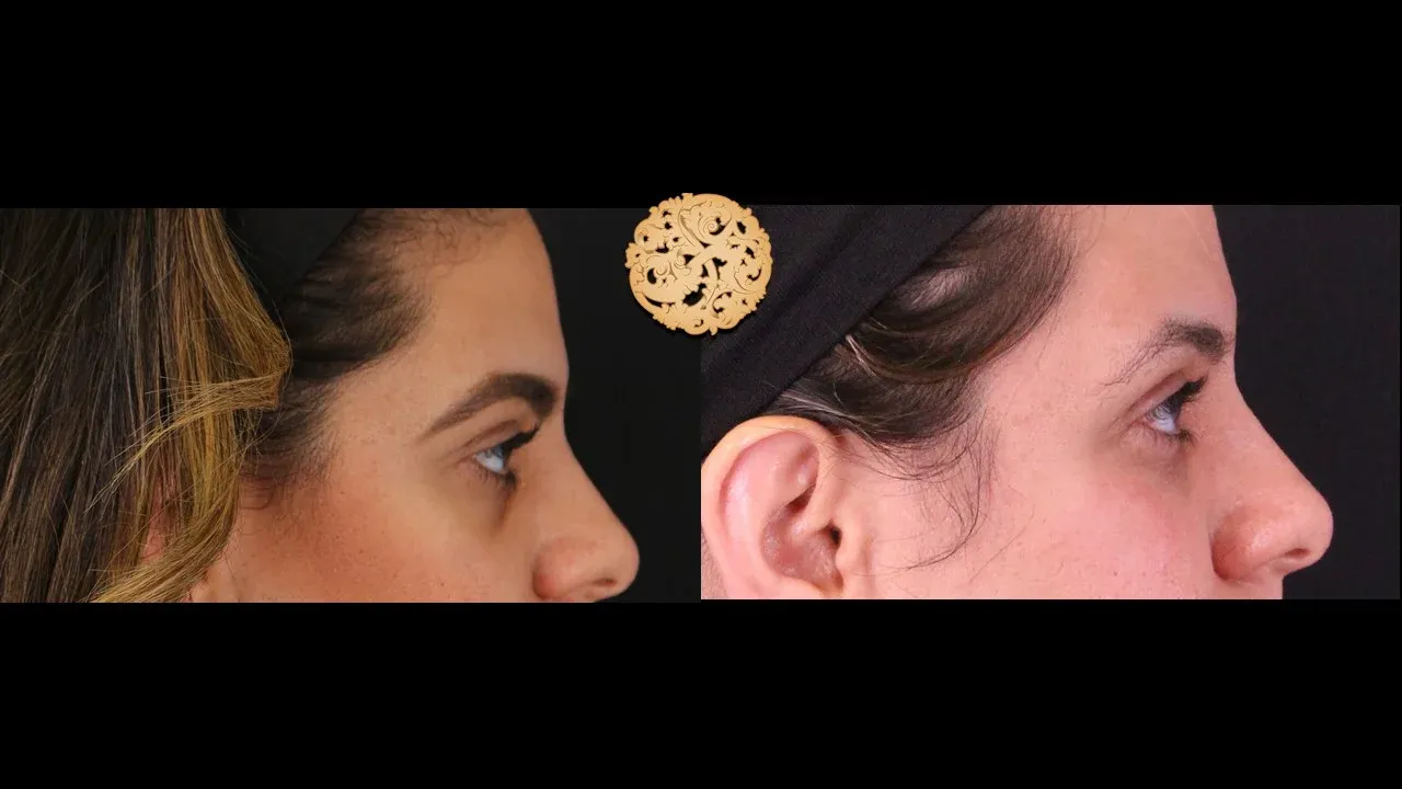 Under Eye Filler Before & After