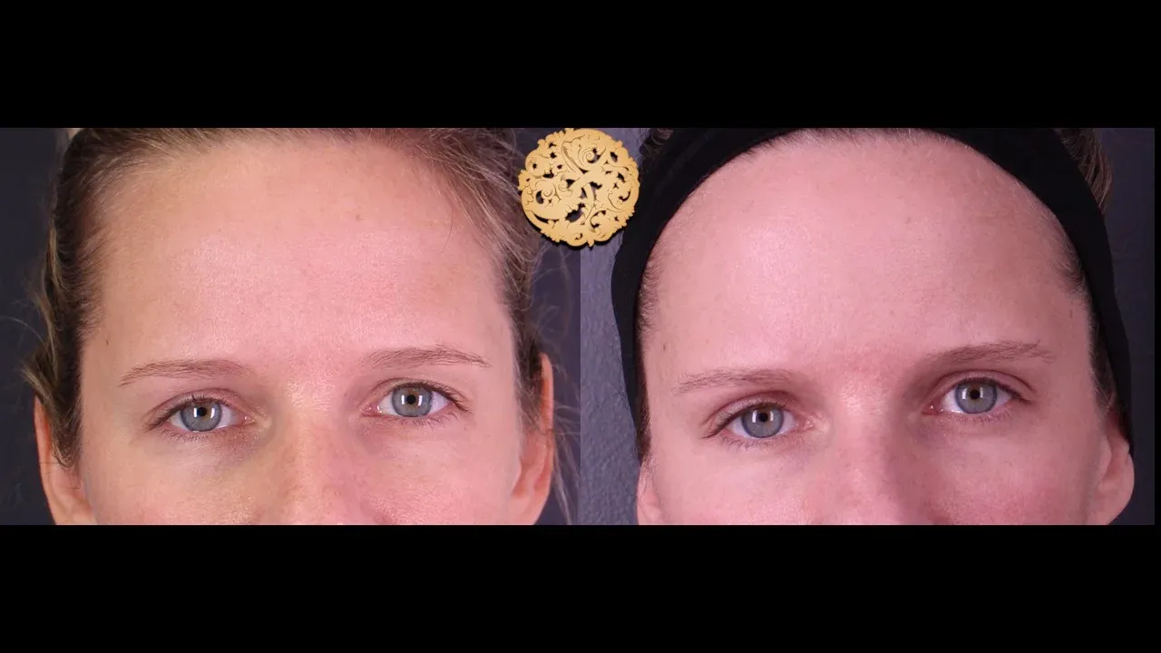 Under Eye Filler Before & After
