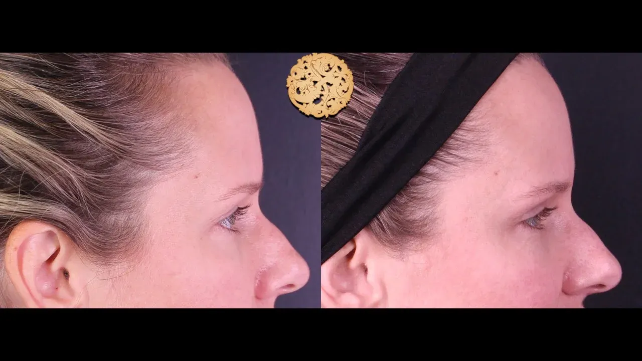 Under Eye Filler Before & After
