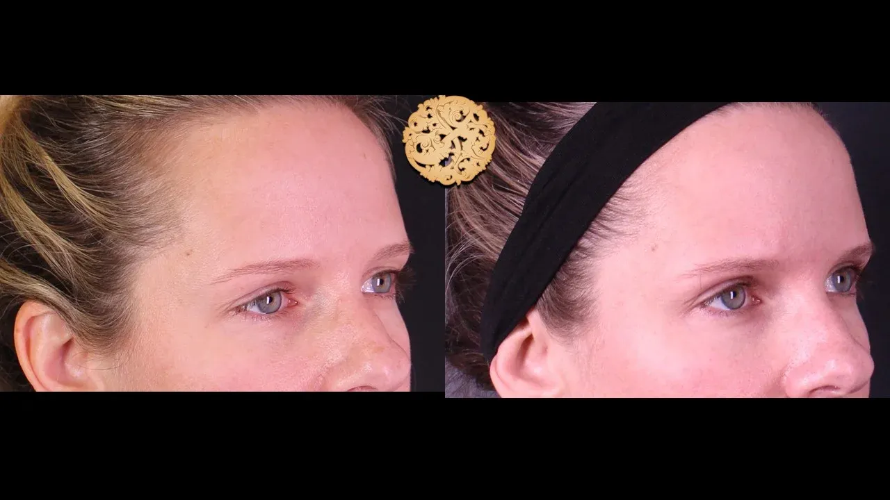 Under Eye Filler Before & After