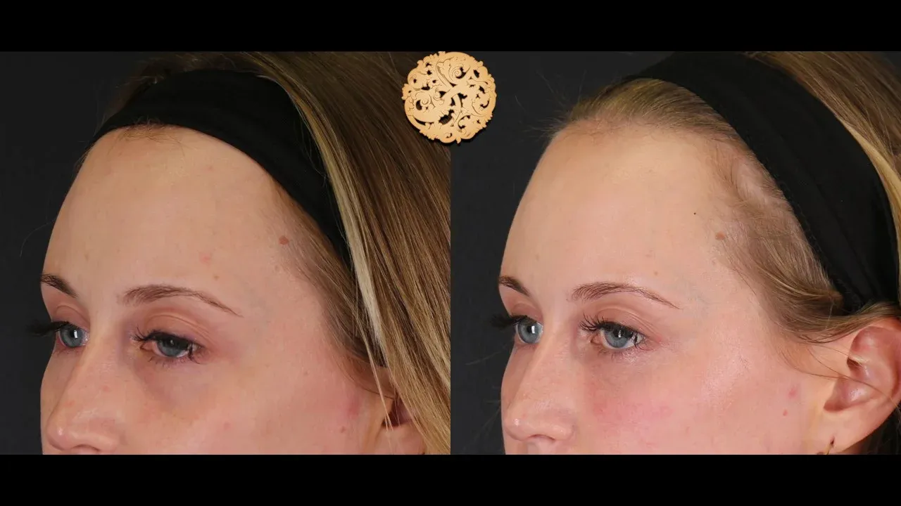 Under Eye Filler Before & After