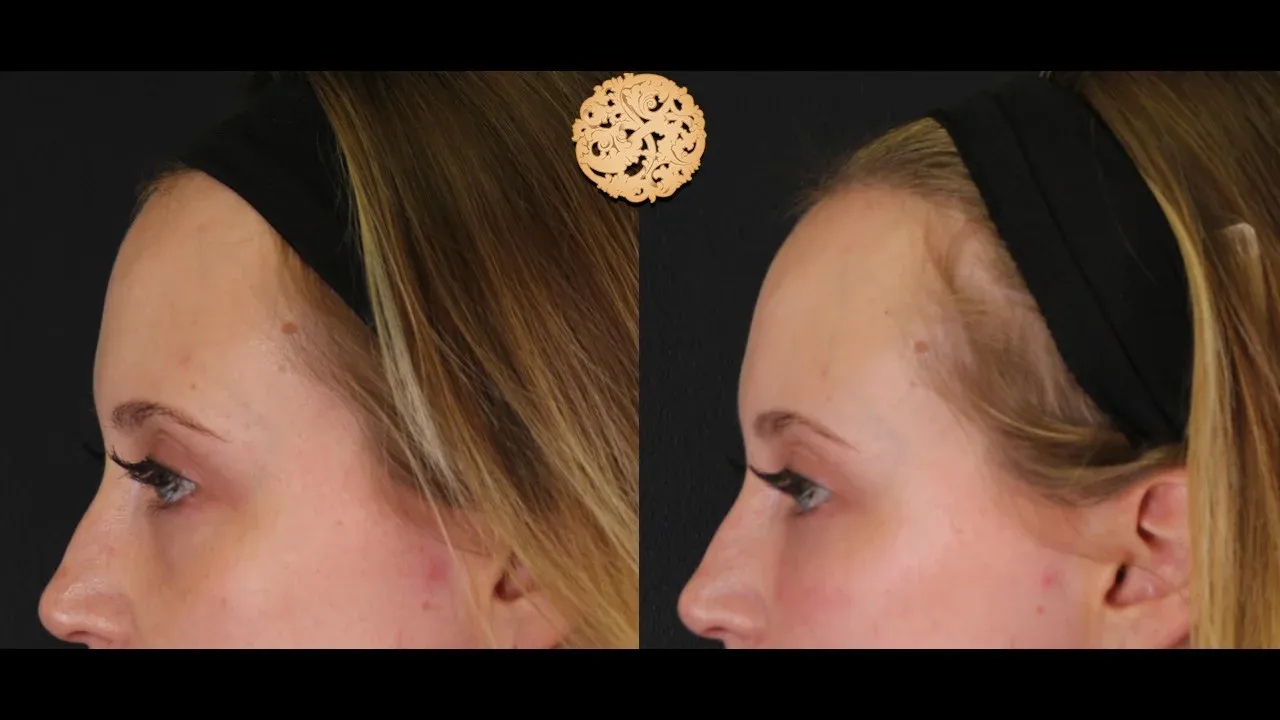 Under Eye Filler Before & After