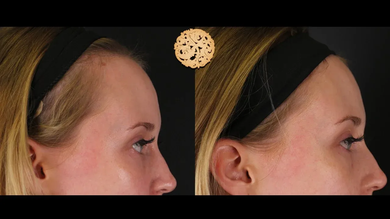 Under Eye Filler Before & After