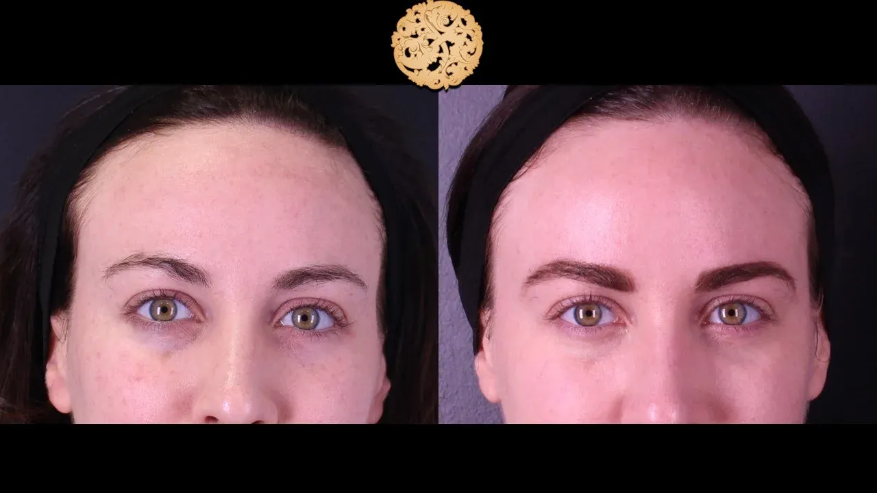Under Eye Filler Before & After