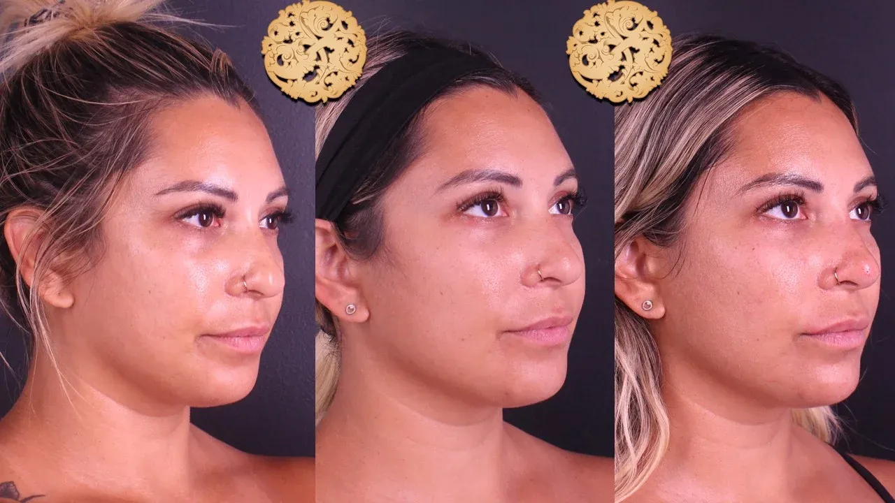 Under Eye Filler Before & After