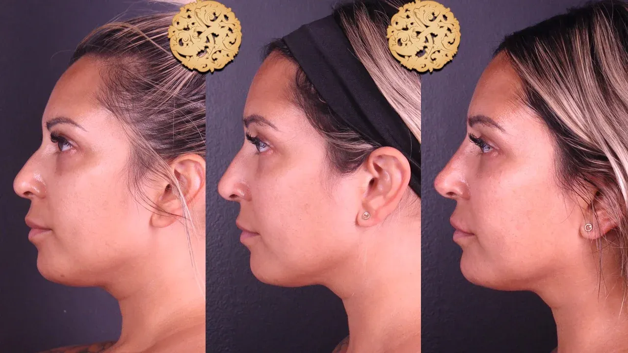 Under Eye Filler Before & After