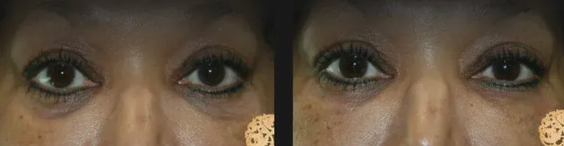 Under Eye Filler Before & After