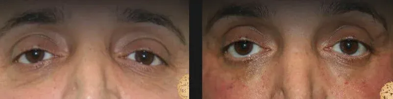 Under Eye Filler Before & After