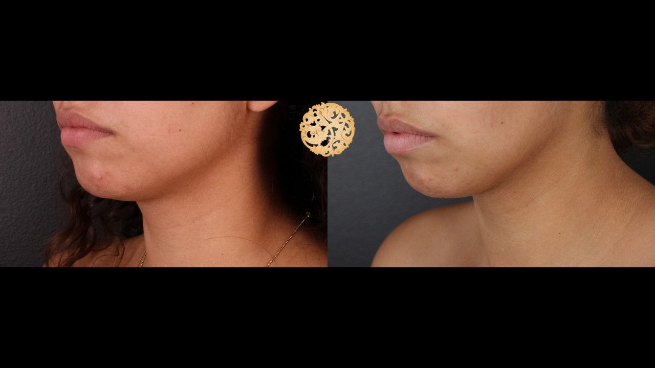 Face Liposuction Before & After