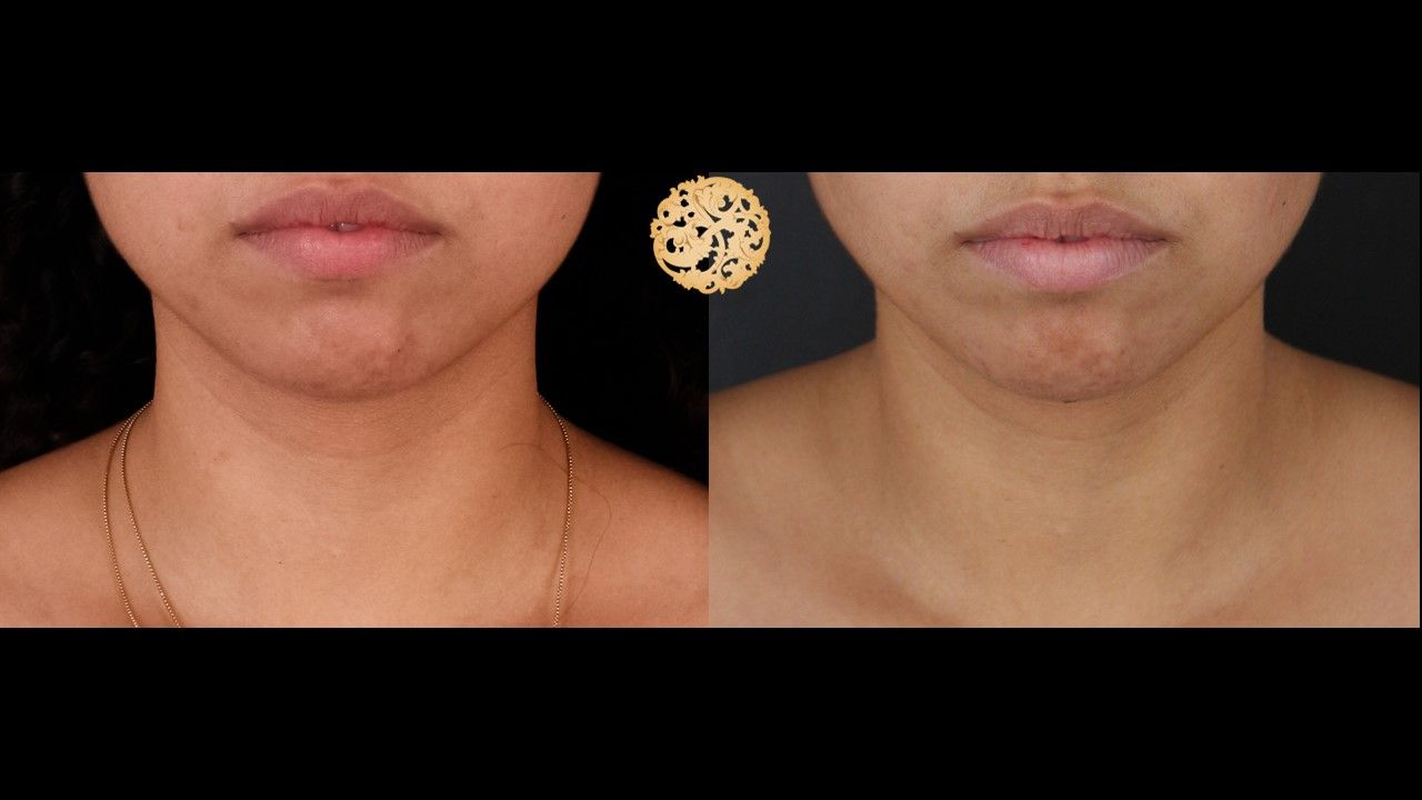 Face Liposuction Before & After