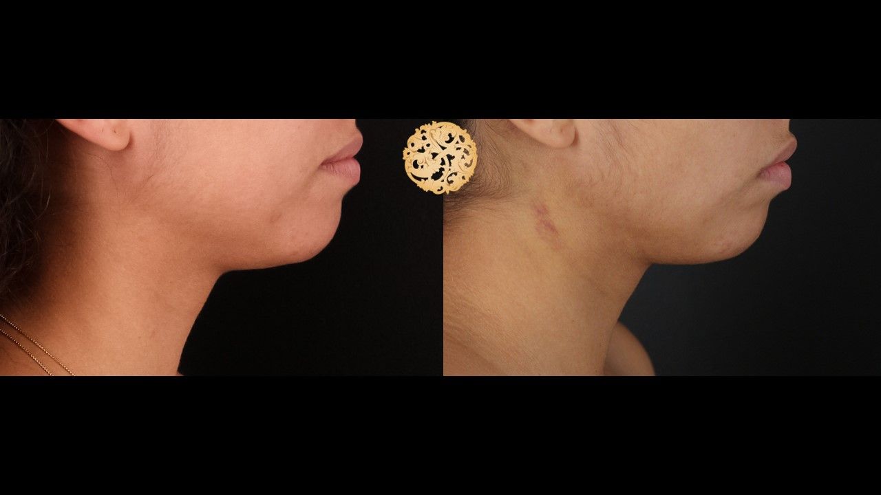 Face Liposuction Before & After