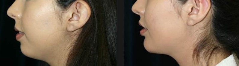 Face Liposuction Before & After