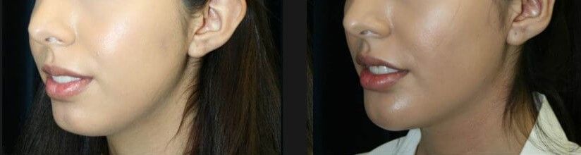 Face Liposuction Before & After