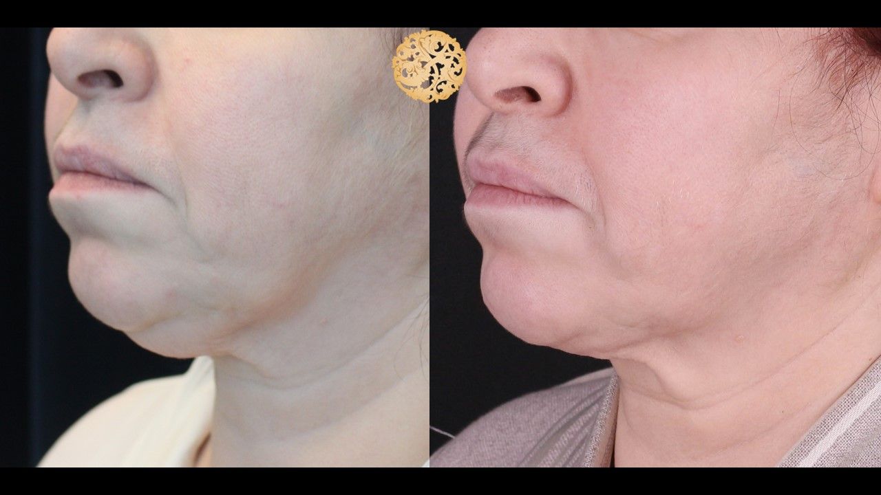 Face Liposuction Before & After