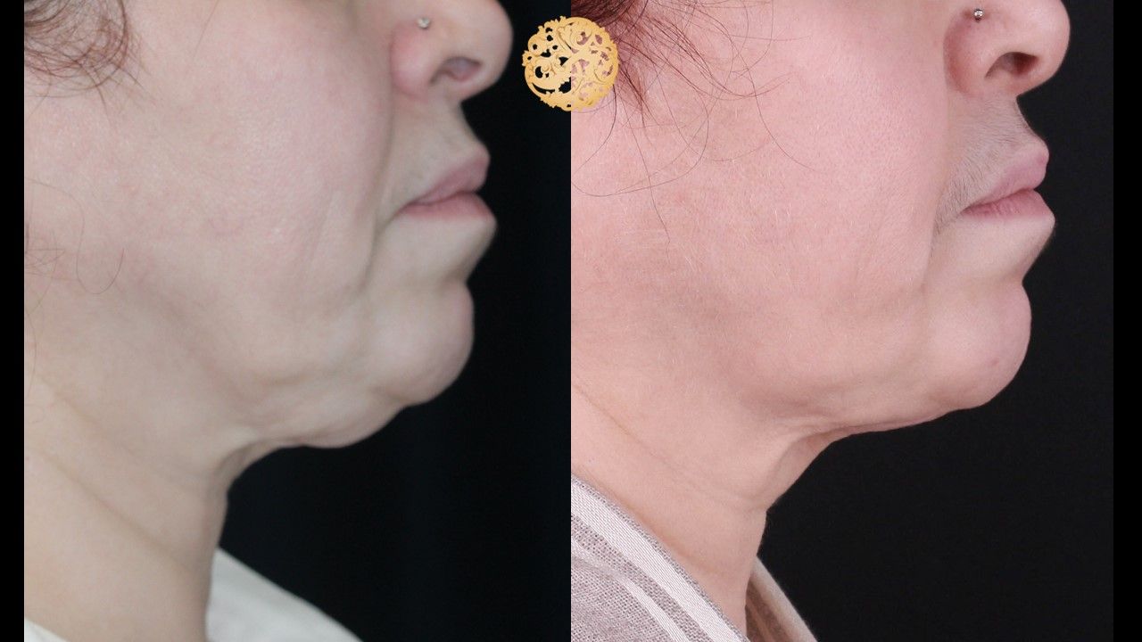 Face Liposuction Before & After