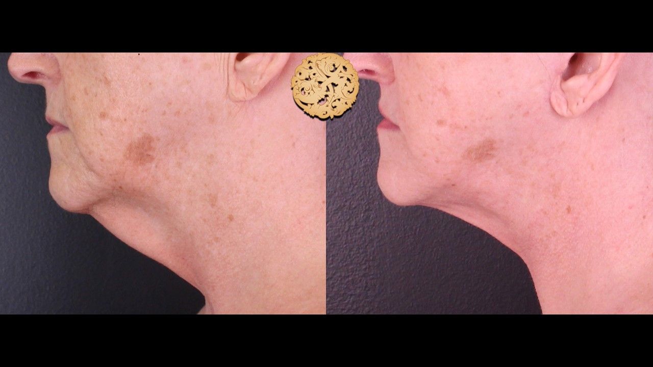 Face Liposuction Before & After