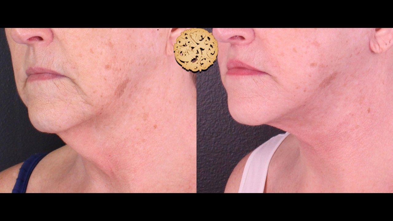 Face Liposuction Before & After