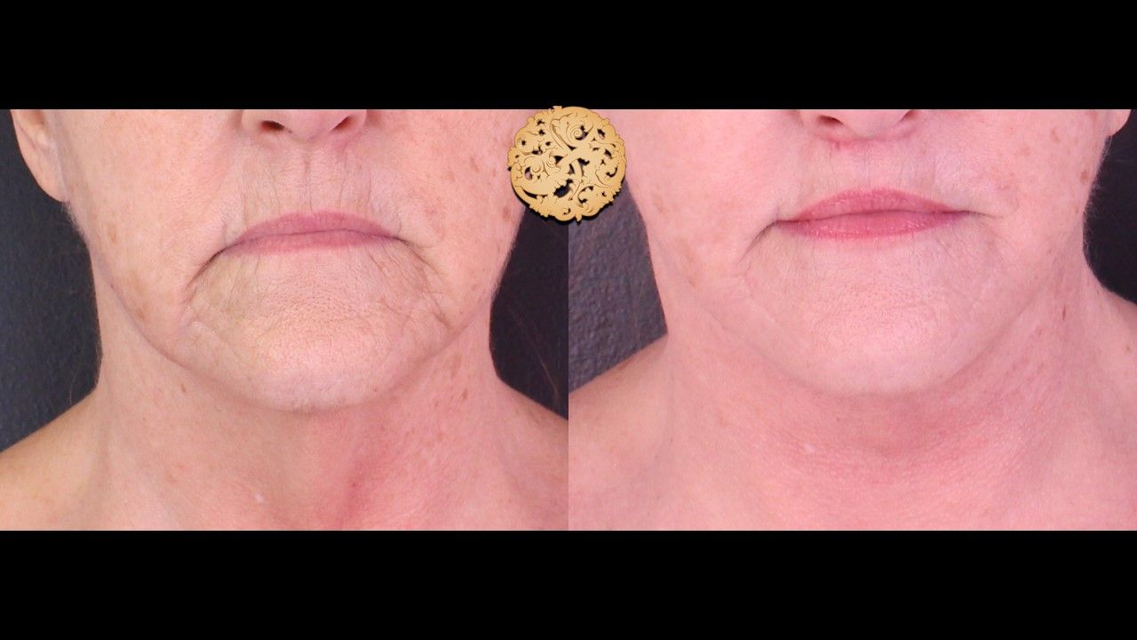 Face Liposuction Before & After