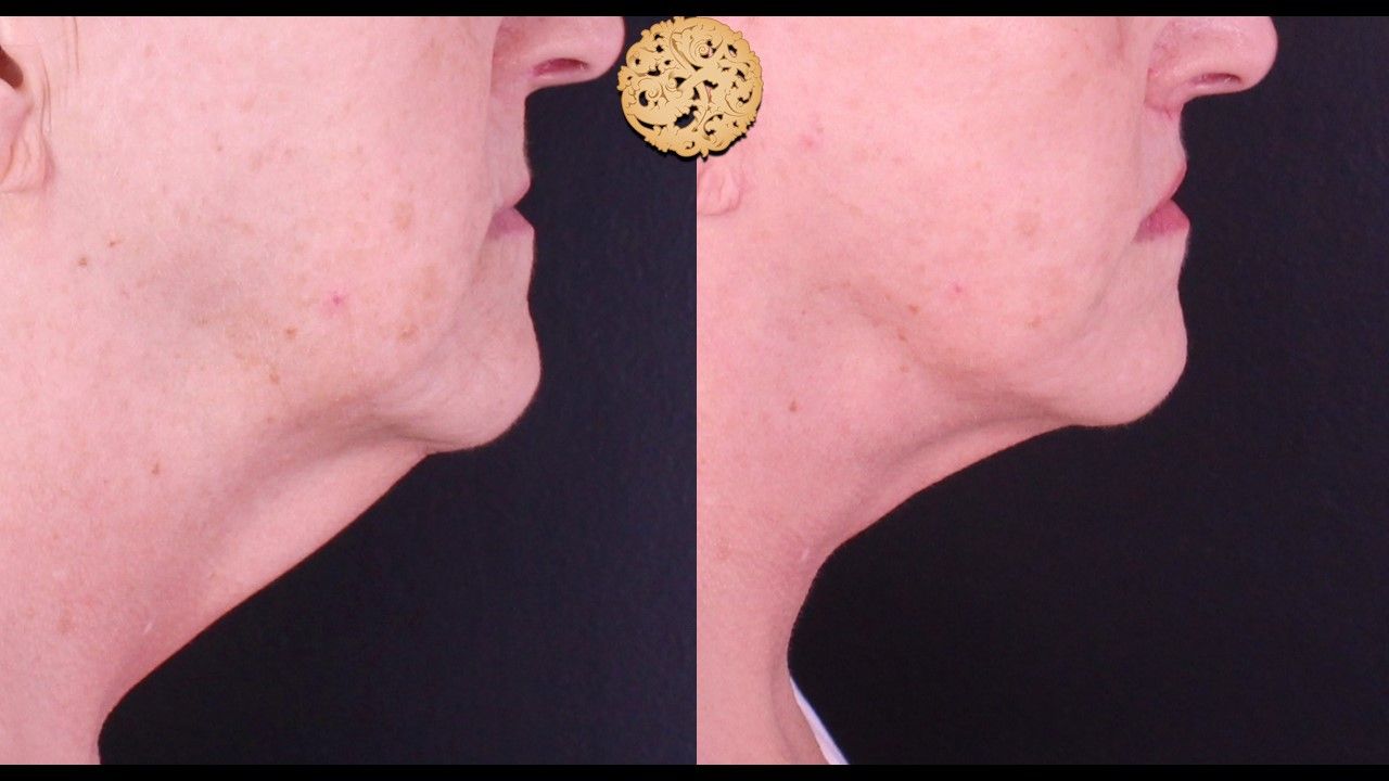Face Liposuction Before & After