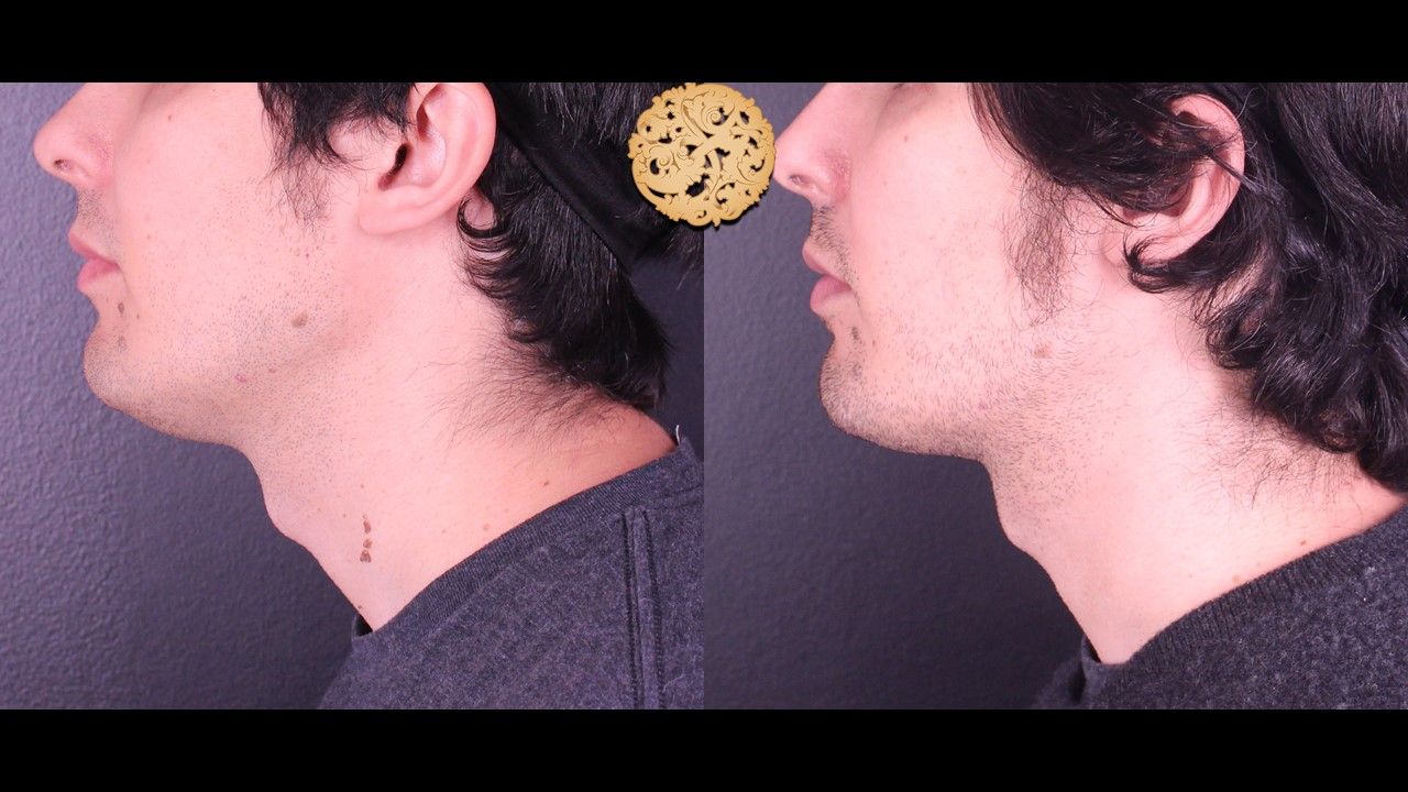 Face Liposuction Before & After