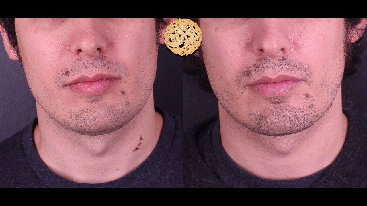 Face Liposuction Before & After