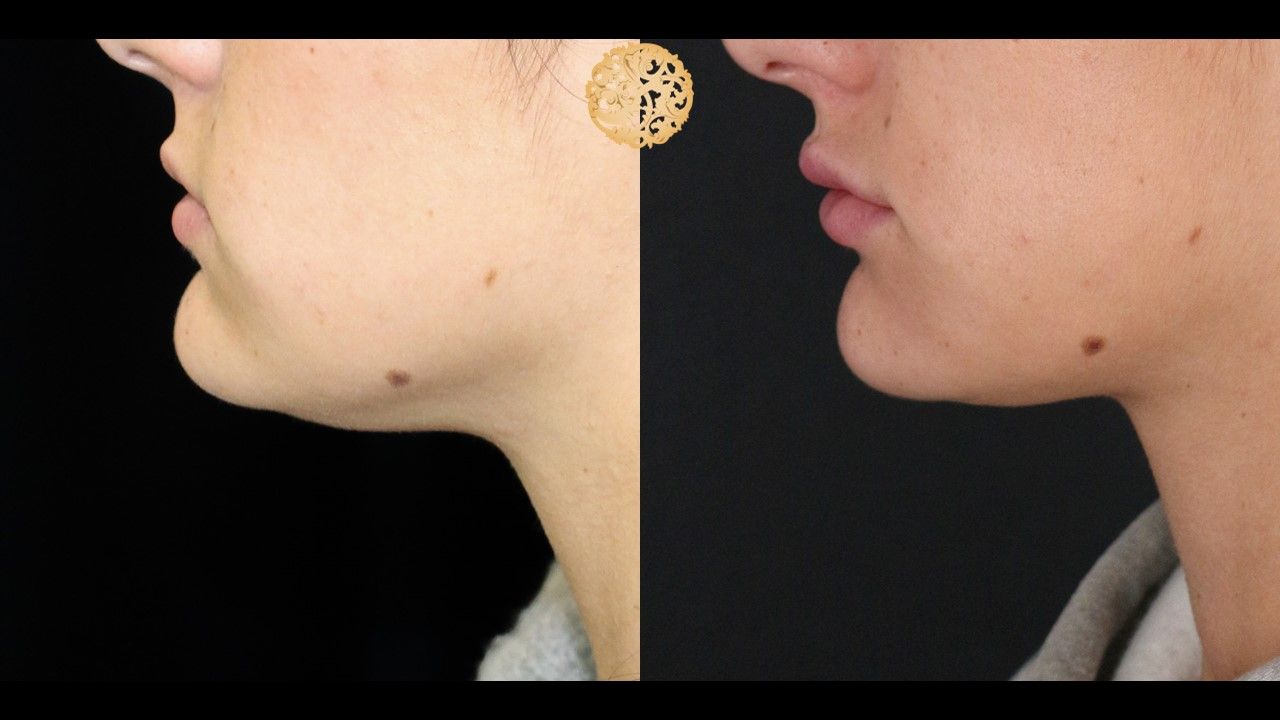 Face Liposuction Before & After