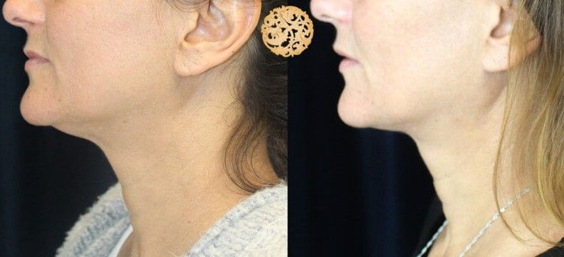 Face Liposuction Before & After