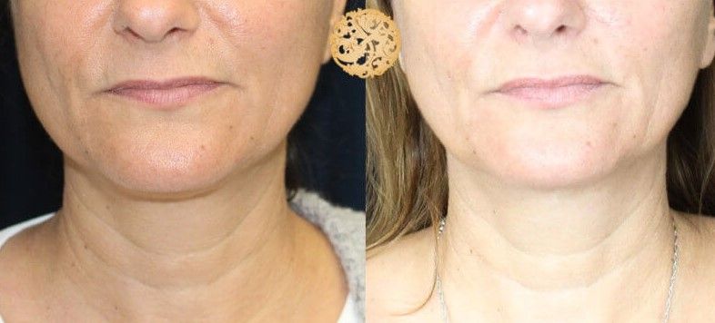 Face Liposuction Before & After