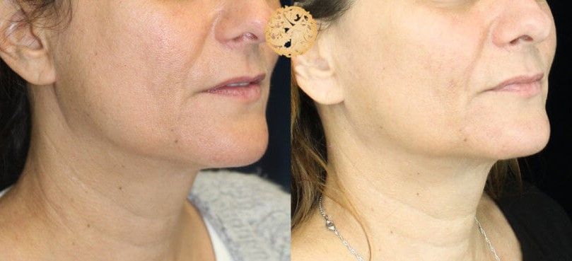 Face Liposuction Before & After
