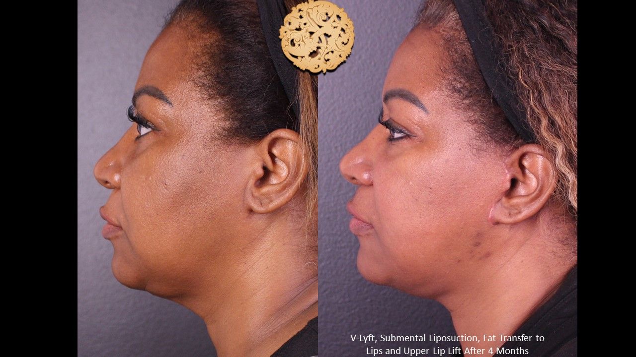 Face Liposuction Before & After