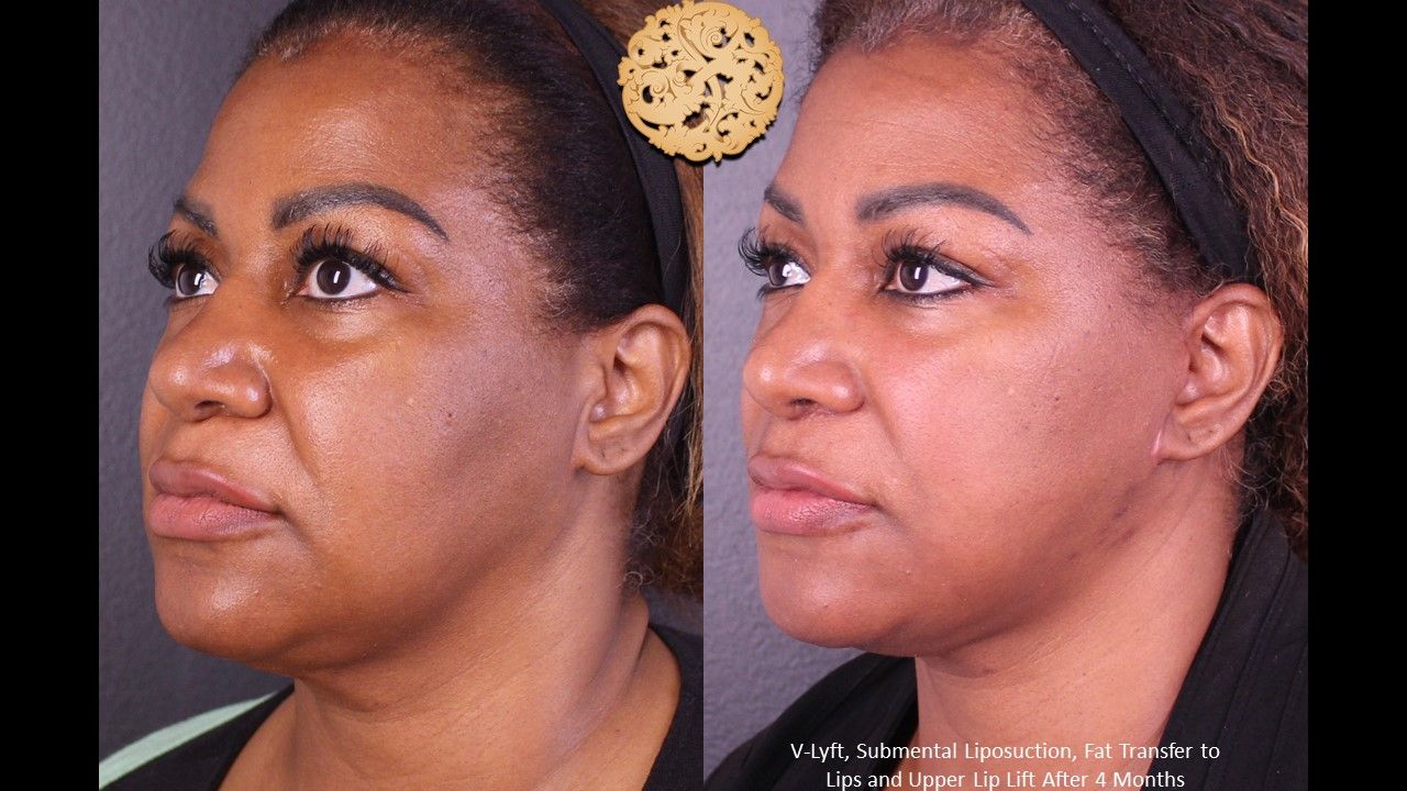 Face Liposuction Before & After