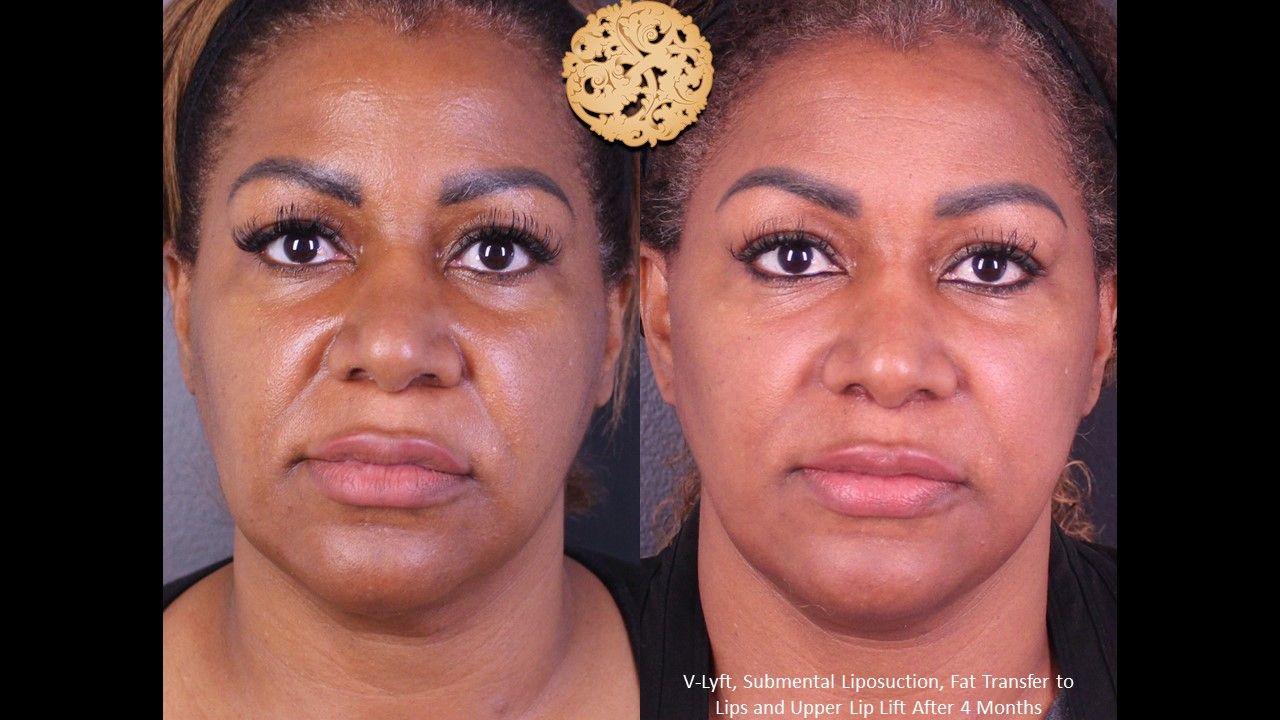 Face Liposuction Before & After
