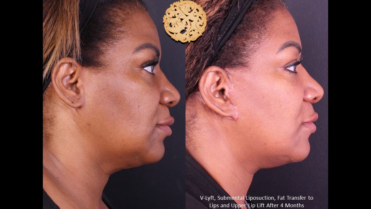 Face Liposuction Before & After