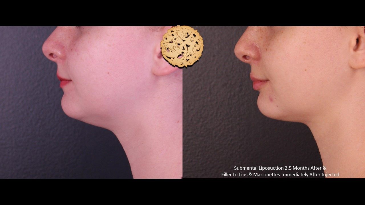 Face Liposuction Before & After