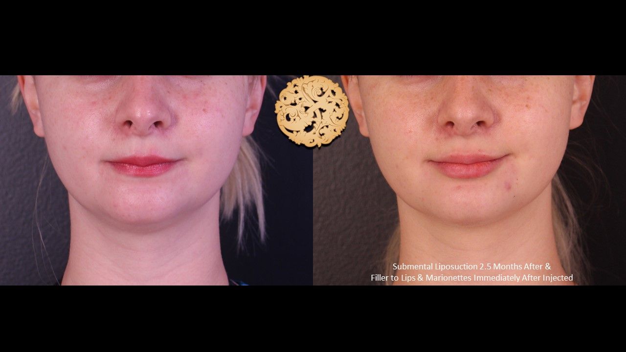 Face Liposuction Before & After