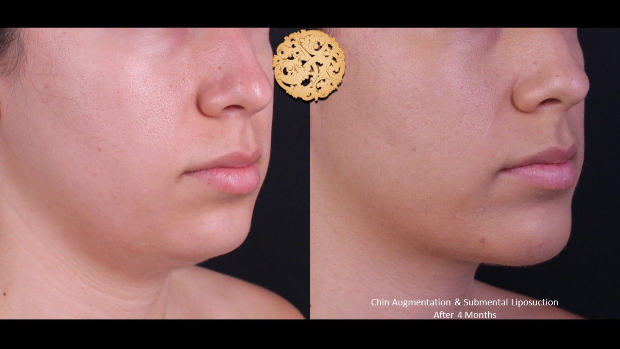 Face Liposuction Before & After