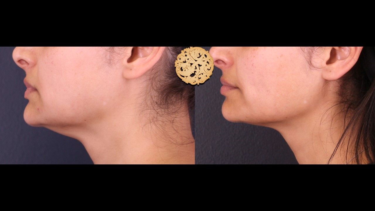 Face Liposuction Before & After