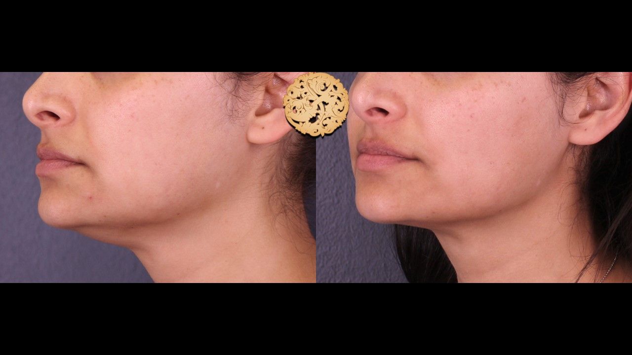 Face Liposuction Before & After