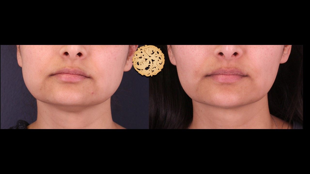 Face Liposuction Before & After