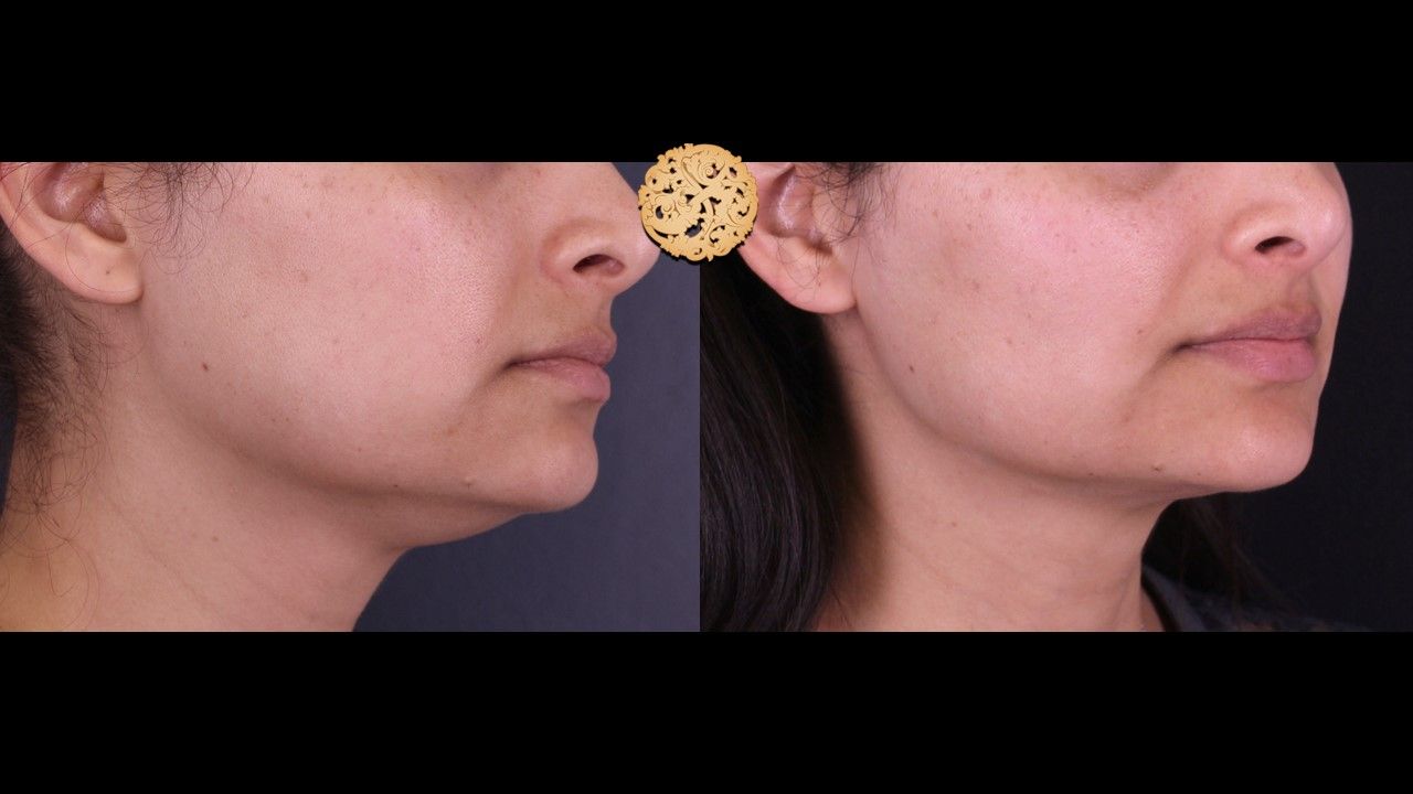 Face Liposuction Before & After