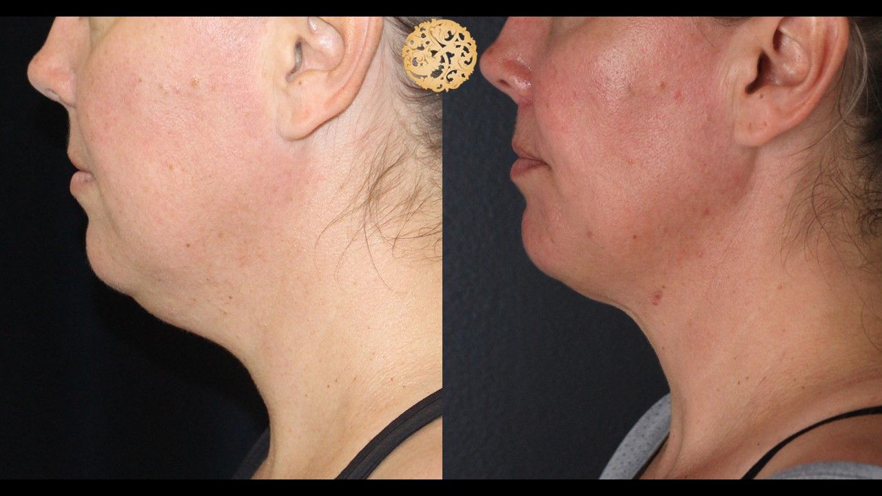 Face Liposuction Before & After