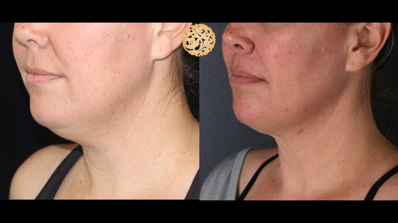 Face Liposuction Before & After