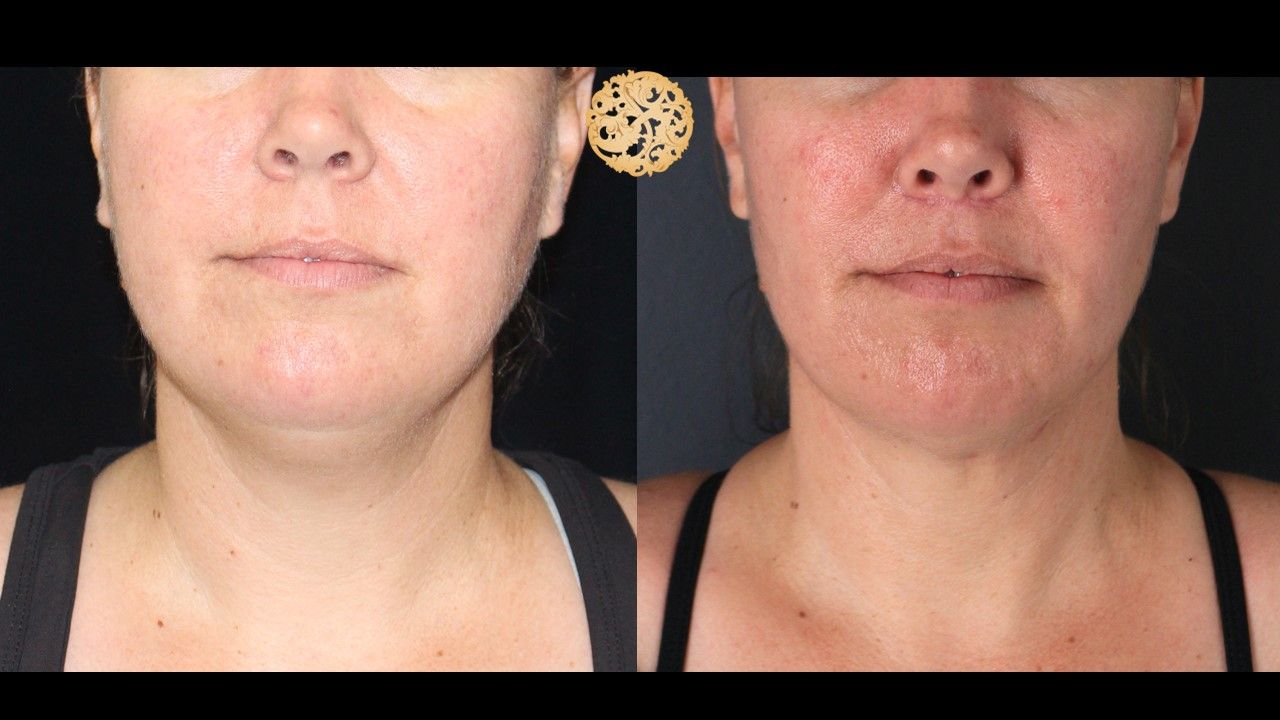 Face Liposuction Before & After
