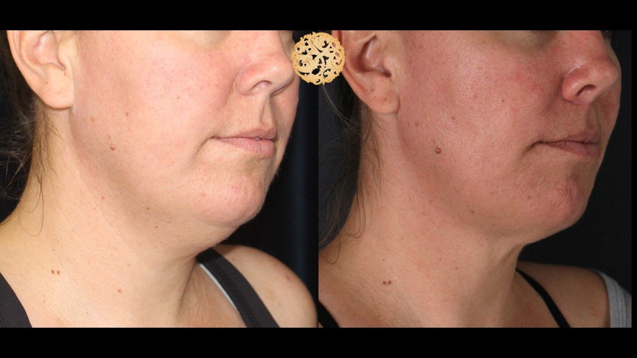 Face Liposuction Before & After