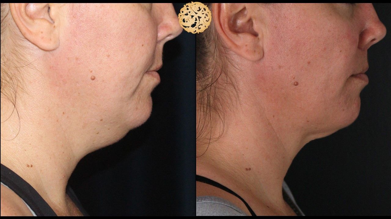 Face Liposuction Before & After