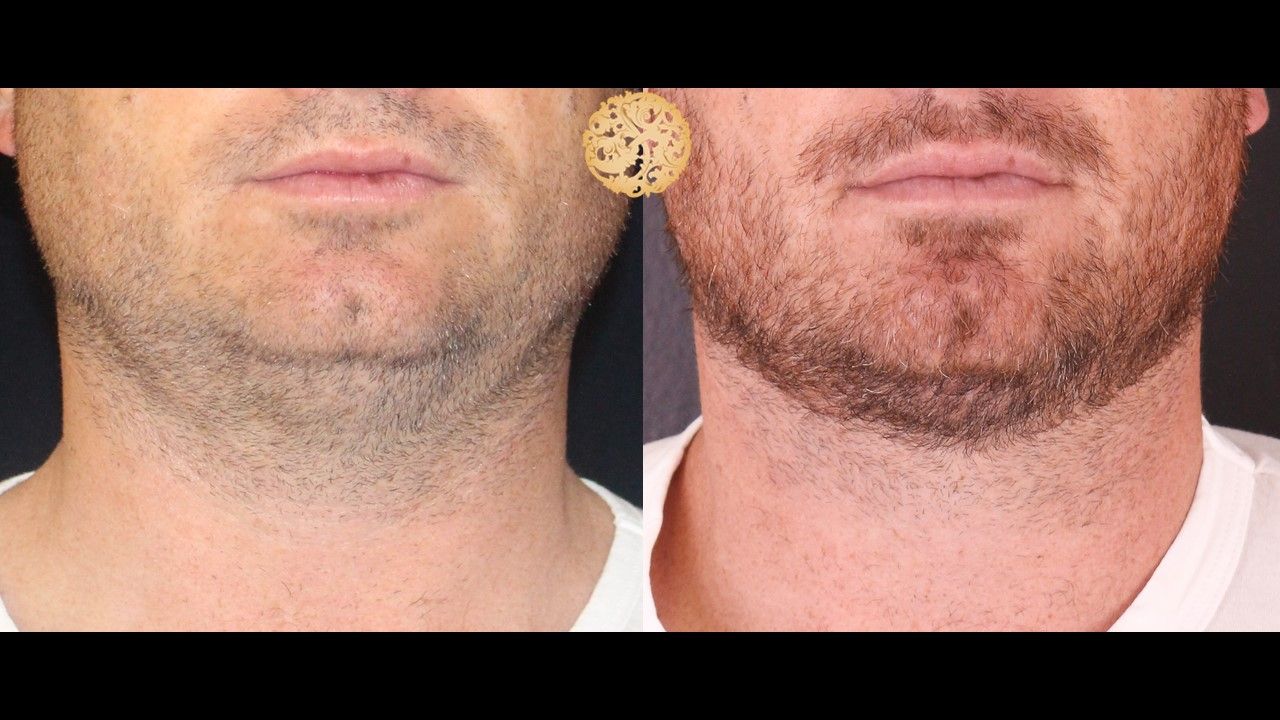 Face Liposuction Before & After