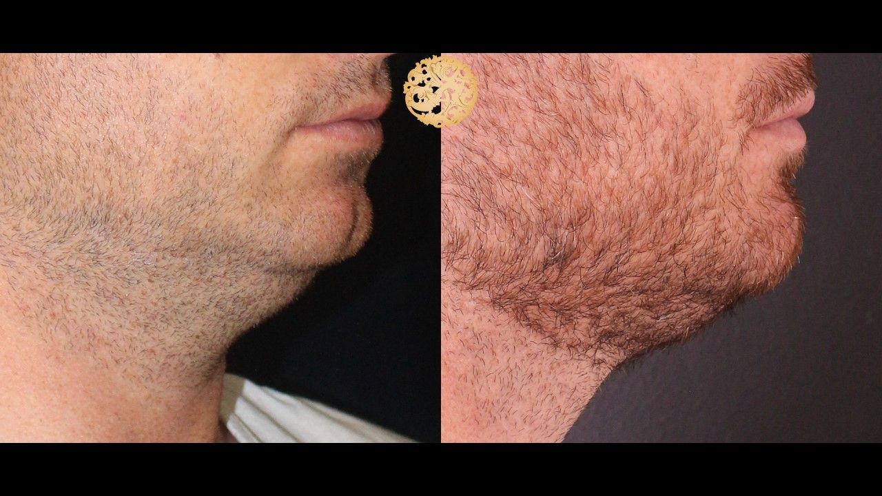 Face Liposuction Before & After